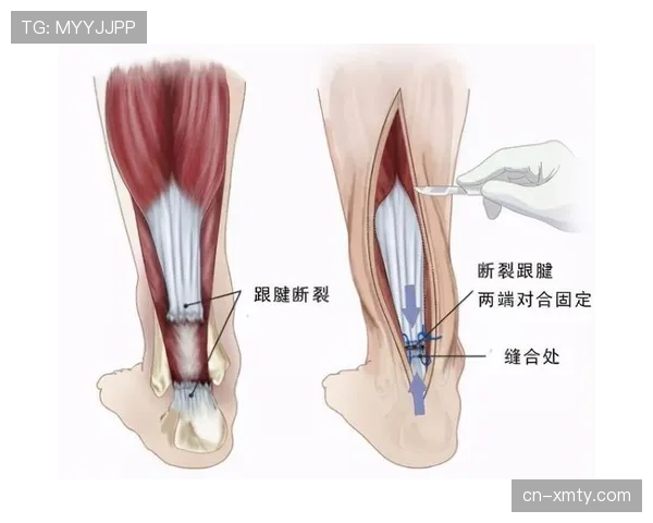跟腱伤需经历三级康复体系 无痛跑动测试避免二次损伤